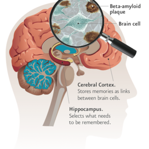 plaque-diagram.-neal-barnard.-power-foods-for-the-brain.-1.14.13.png